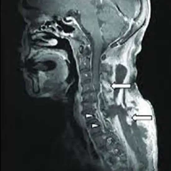 MRI Neck With Contrast